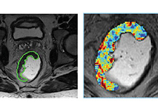 VA researchers using AI to decide best treatment for rectal cancer