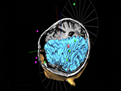 Study shows safety of brain stimulation together with exposure therapy for PTSD