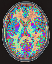 Modest brain changes seen in patients with schizophrenia after computer exercises