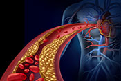 Detecting coronary heart disease using genetic data