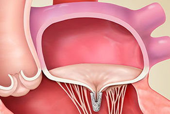 mitraclipmitralregurgitation350x235v1